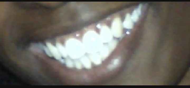 Dents blanches - 1