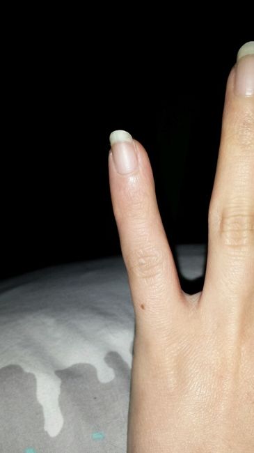 Huile De Ricinlevure De Bière Résultat Ongle Beauté