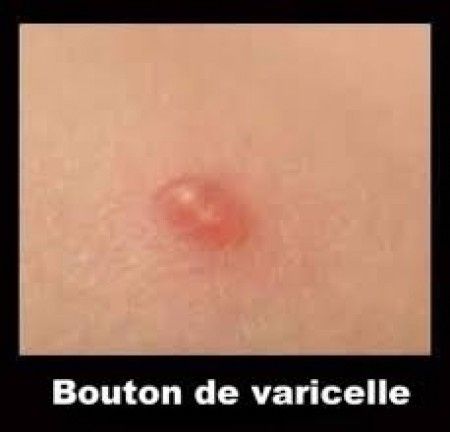 boutons varicelle