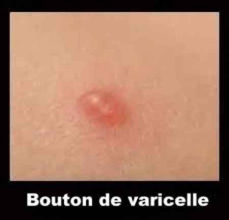 boutons varicelle