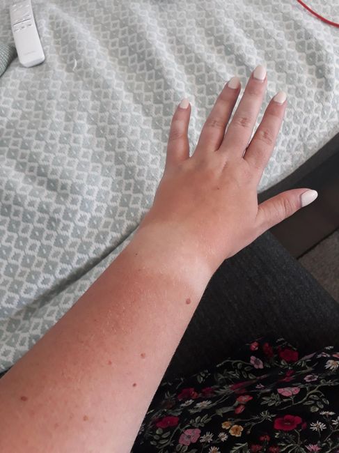 Marque bronzage : bracelet ? - 1
