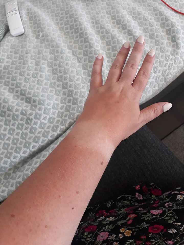 Marque bronzage : bracelet ? 3