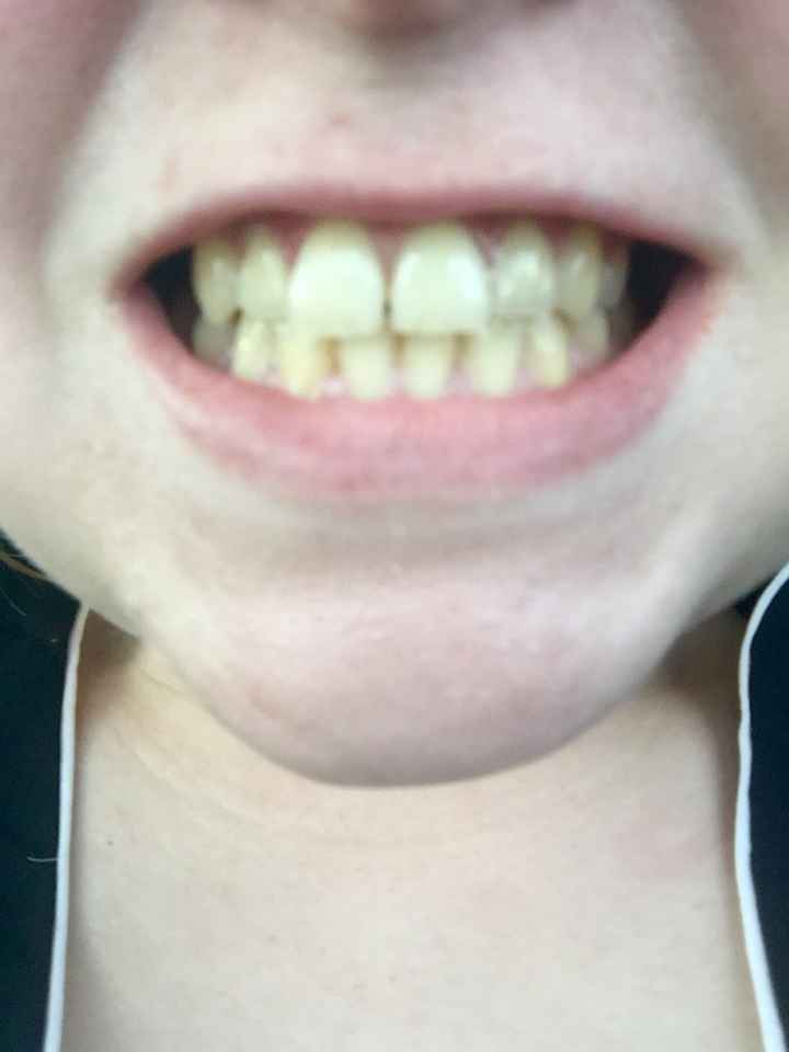 J'ai trouvé le produit pour blanchir les dents !!! - 1
