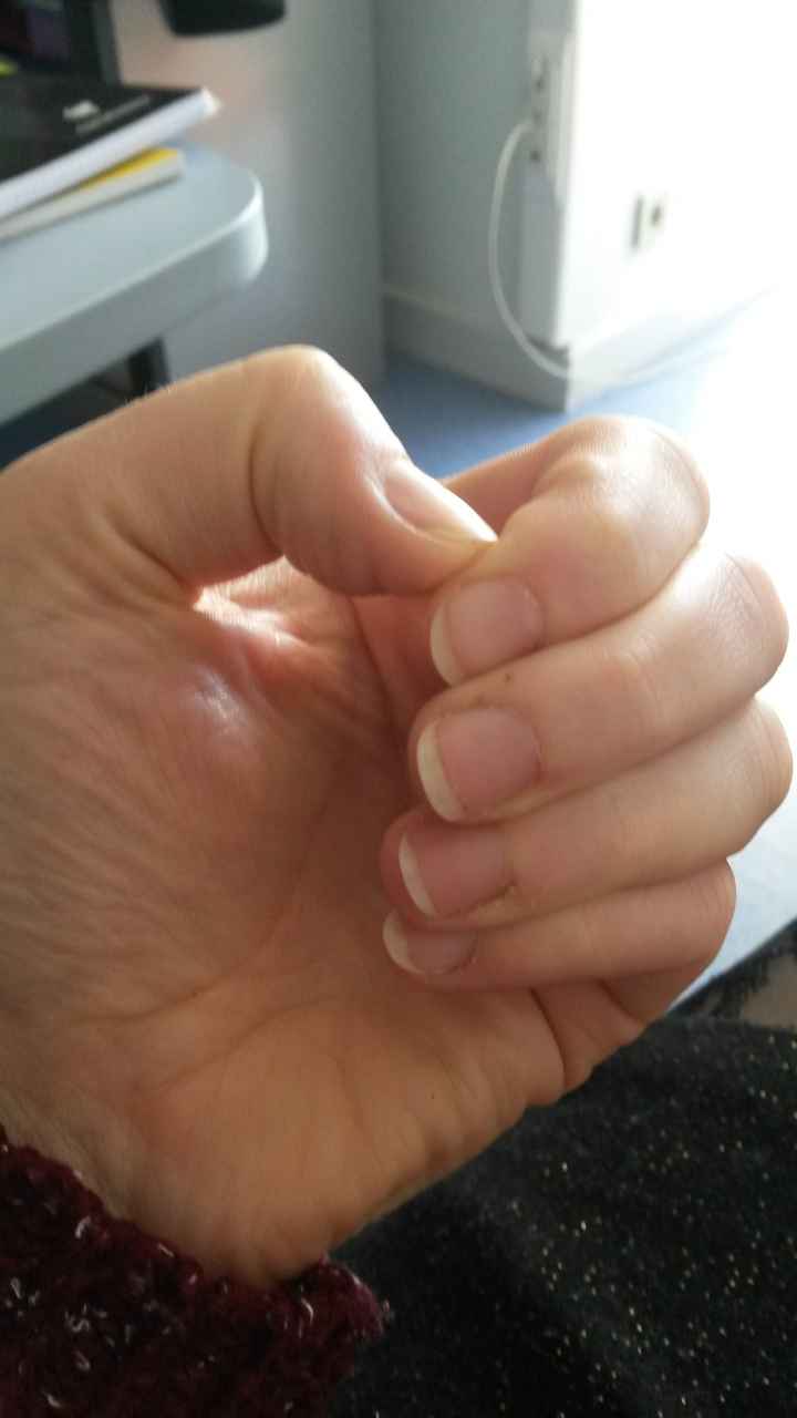 Stop j arrêté de ronger mes ongles - 1