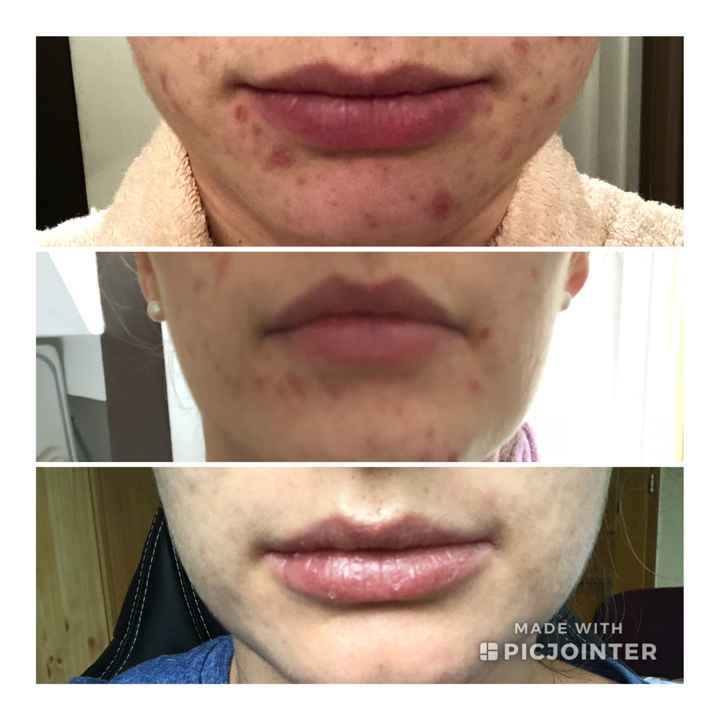 Fin traitement roaccutane, résultats ! - 1