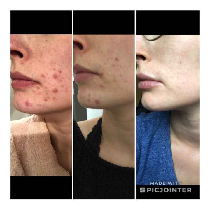 Fin traitement roaccutane, résultats ! - 3