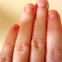 Ongles rongés - 1