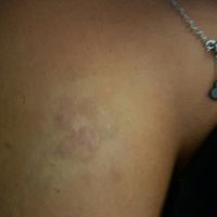 Cicatrice comment la cacher - 1