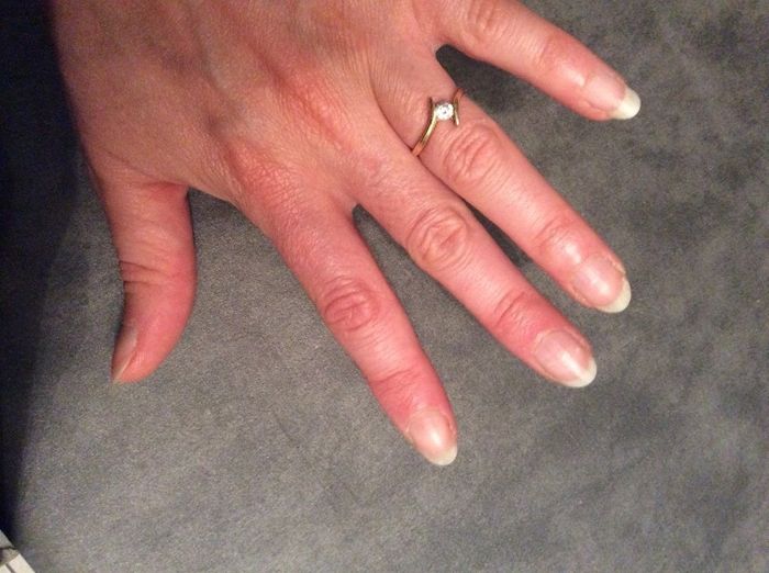 Ongles