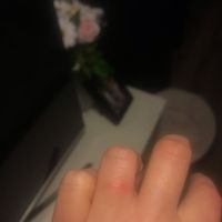 Réaction peau bague fiançailles - 3