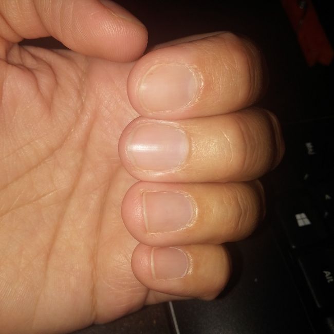 Ongles