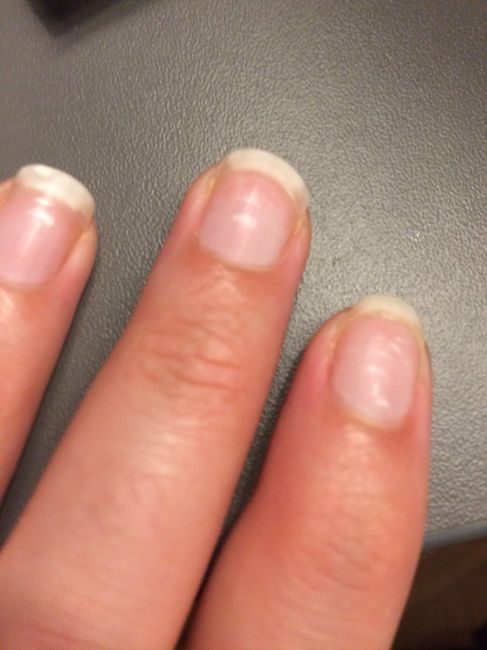 Help ! comment remédier aux tâches blanches sur les ongles ? - 1