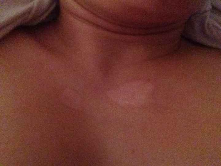 Lésions irréversibles .... - 1