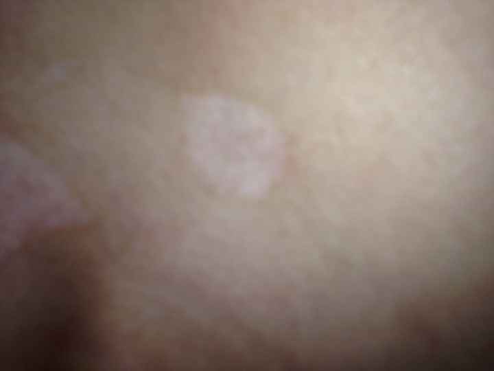 Lésions irréversibles .... - 2