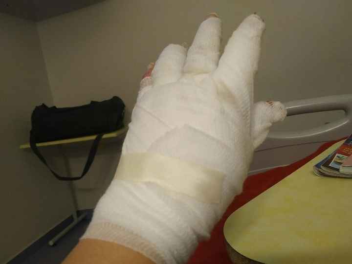 Brûlée 2 et 3 eme degré a 2 mois du mariage - 3
