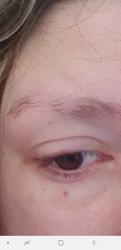 La cata sourcil apres operation - 4