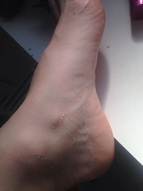 Peeling baby foot - 1