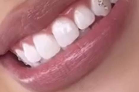Strass dentaire