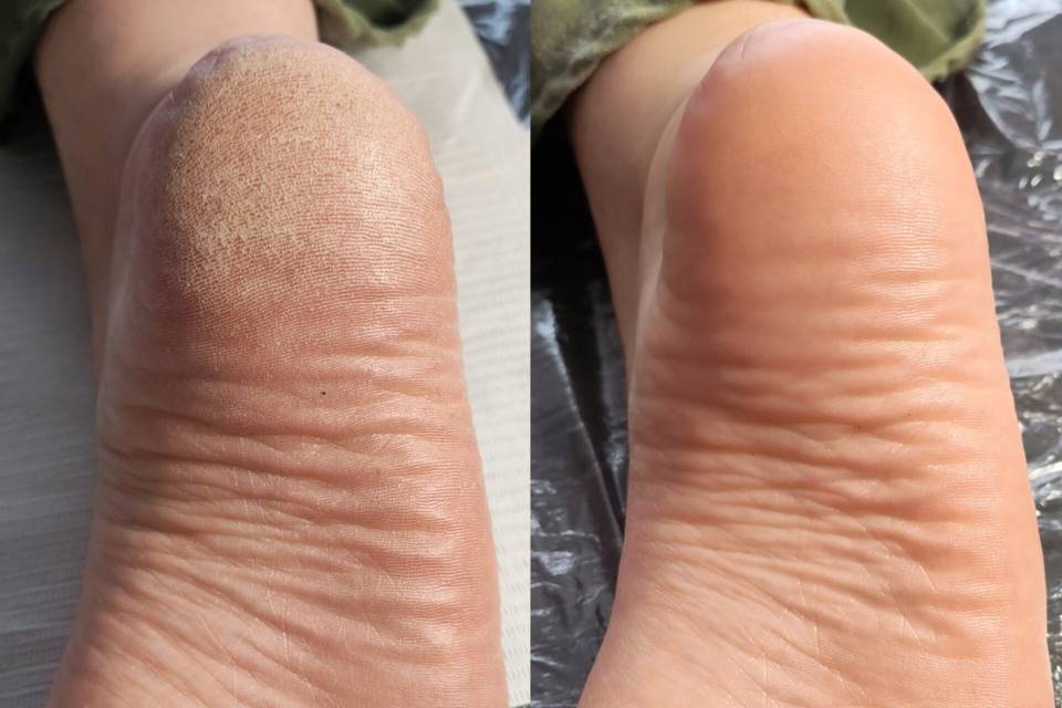 Soin expert pieds