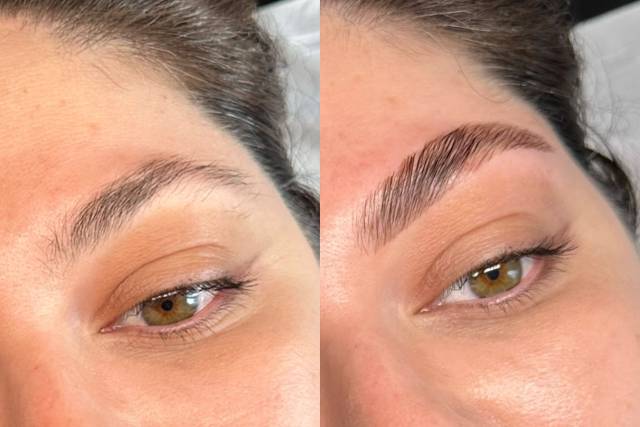 Browlift