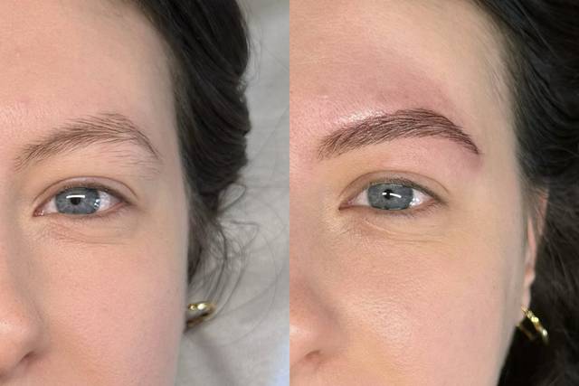 Browlift