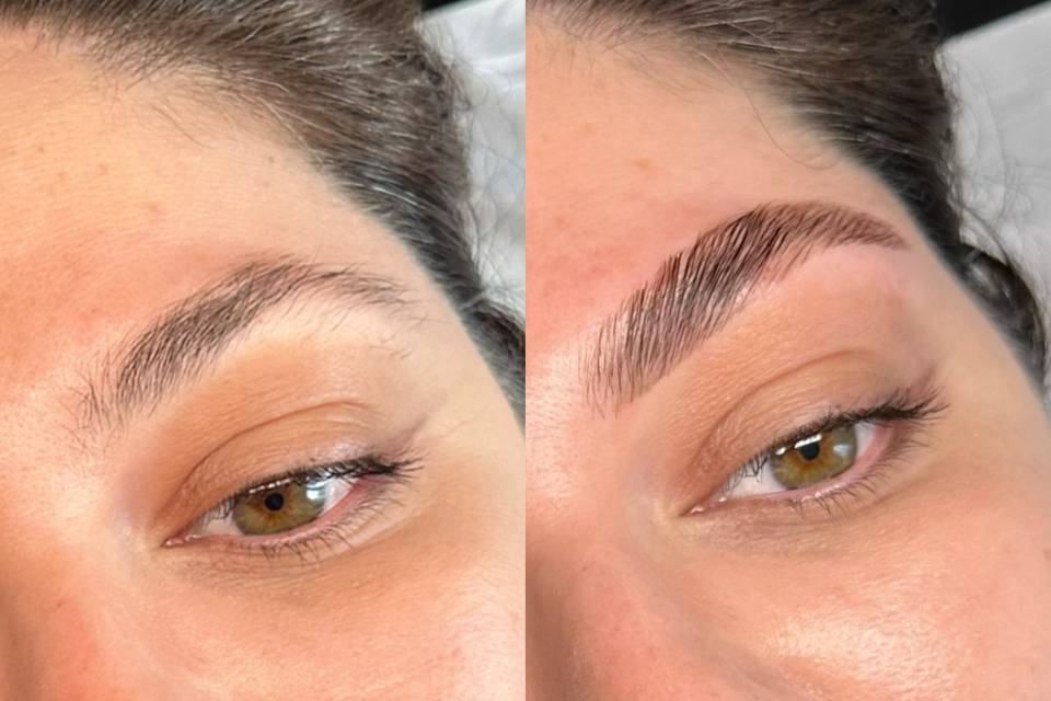 Browlift