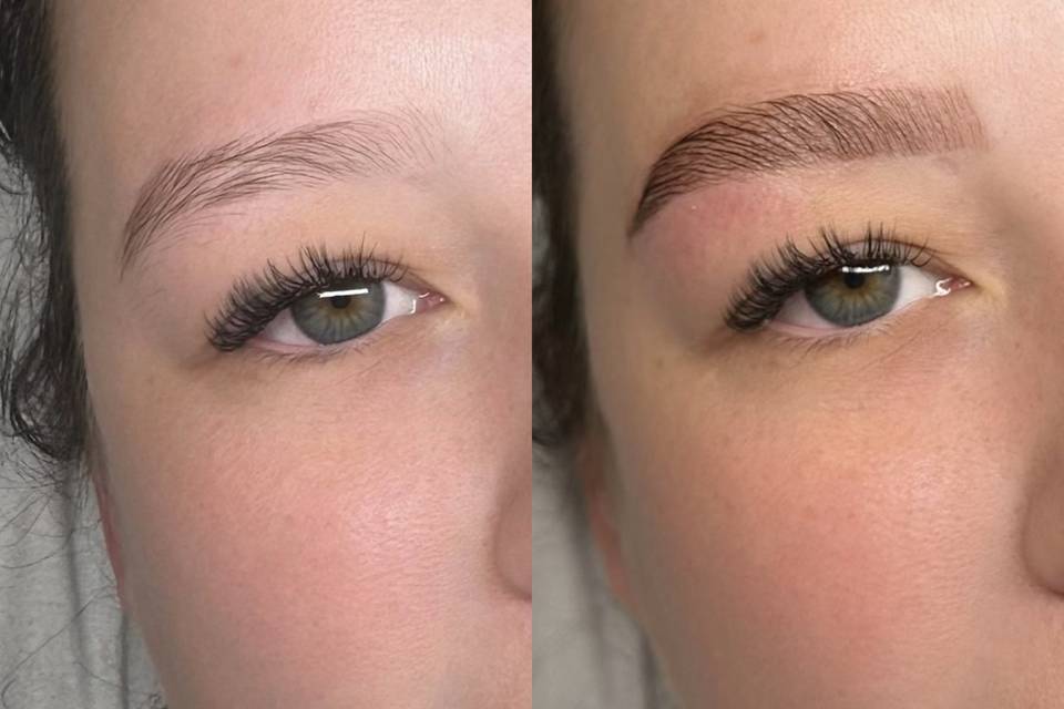 Browlift