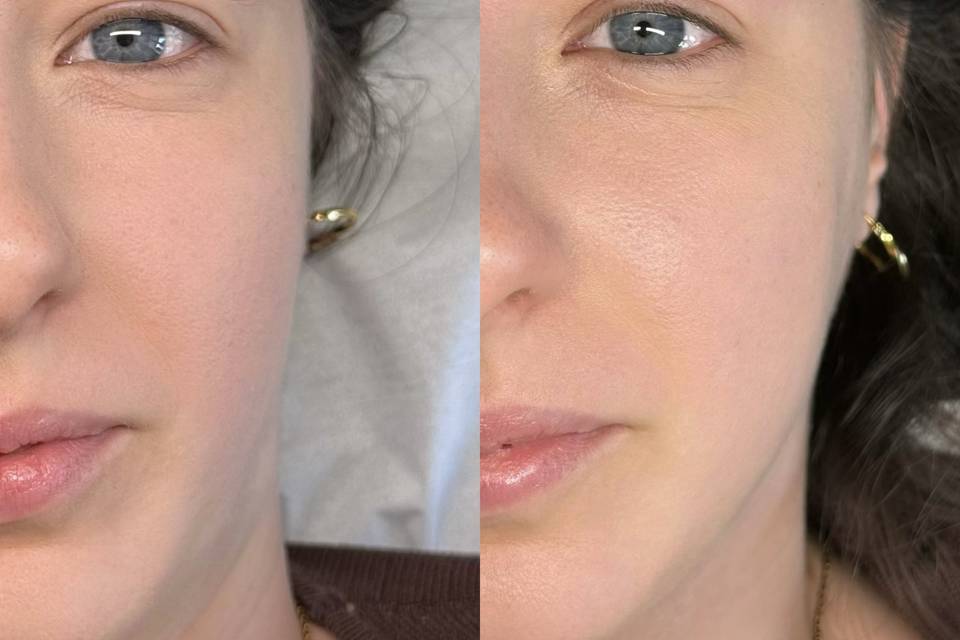 Browlift