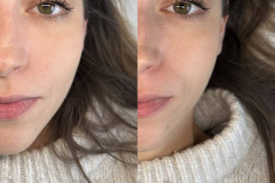 Browlift