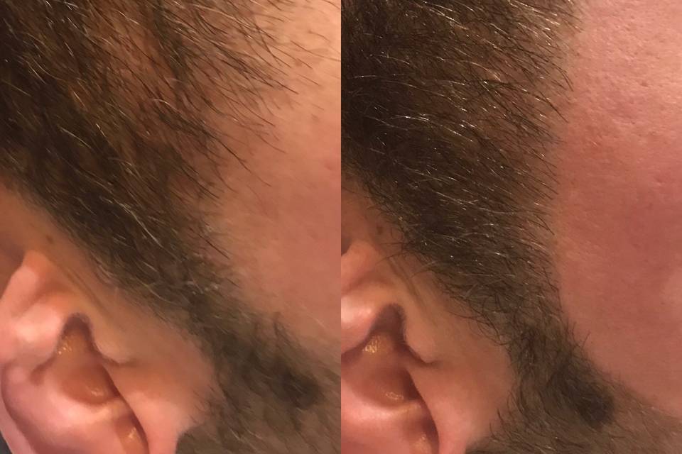 Épilation barbe
