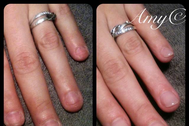 Reconstruction ongles rongés