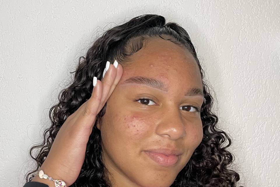 Brow lift