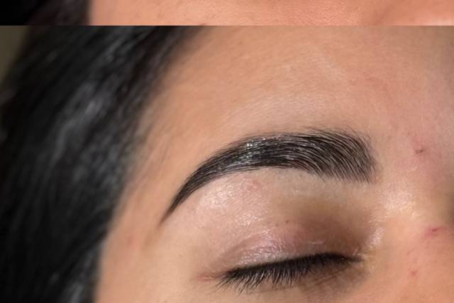 Browlift