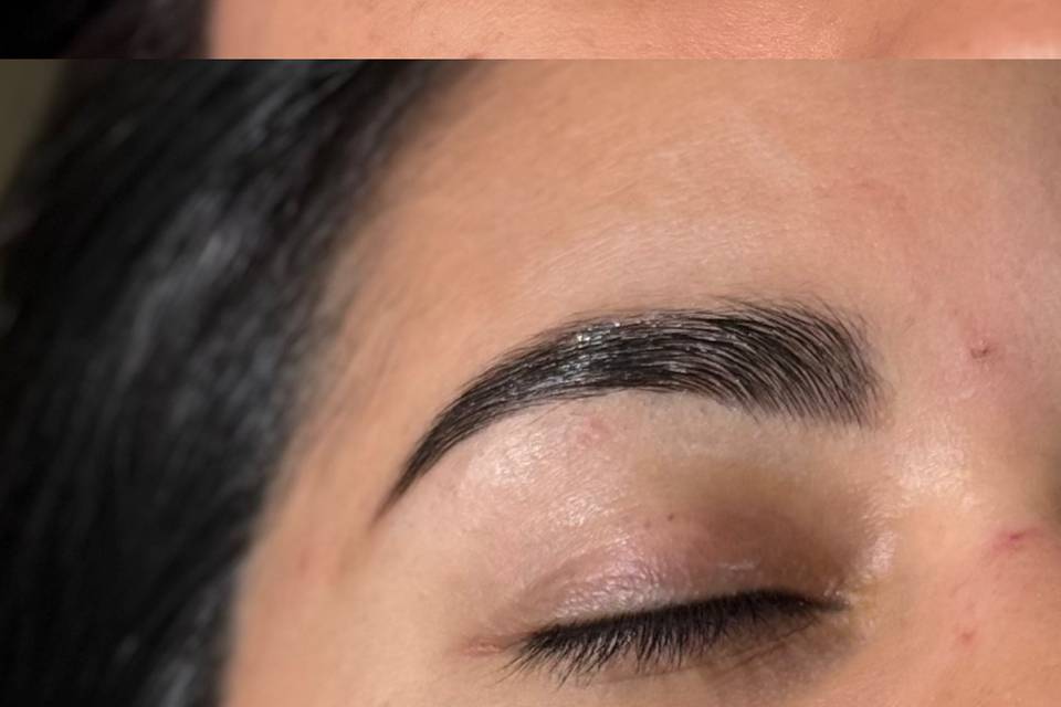 Browlift