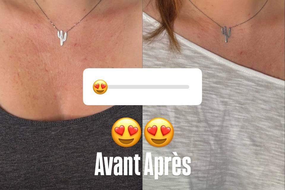 Avant après