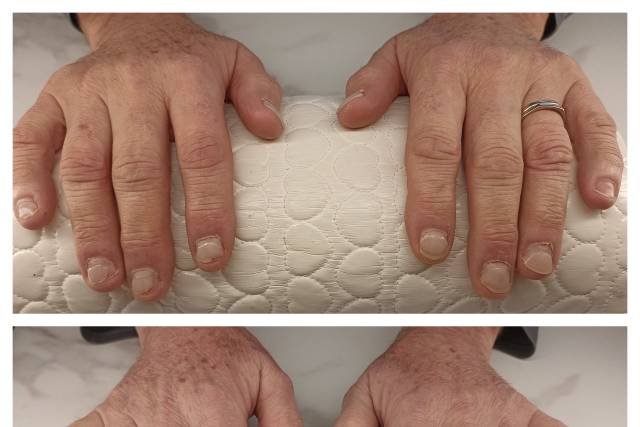 Reconstruction ongles rongés