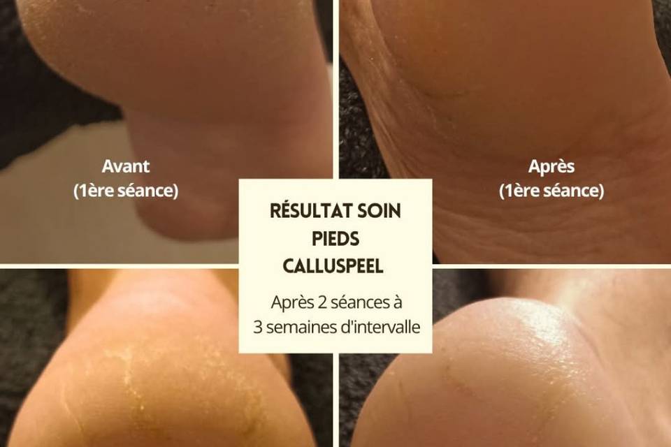 Soin des pieds Calluspeel