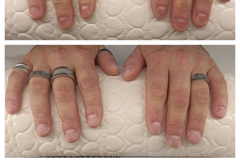 Reconstruction ongles rongés
