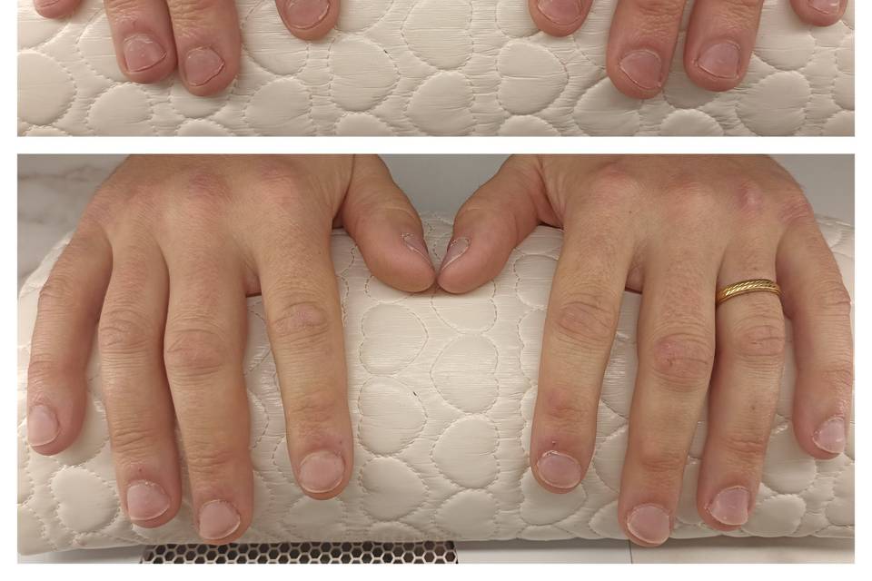 Reconstruction ongles rongés