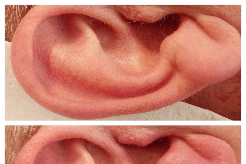 Épilation oreilles à la cire