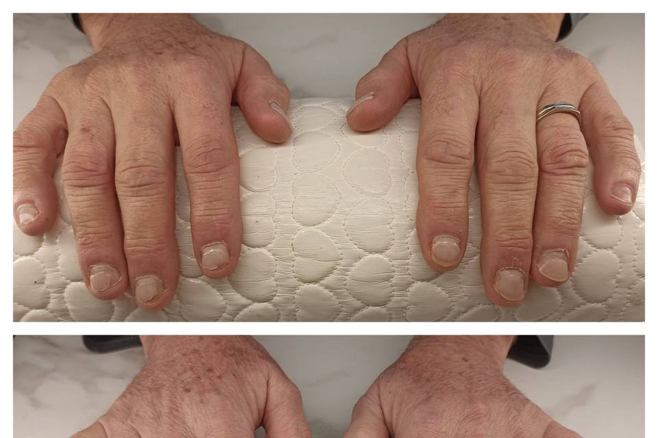Reconstruction ongles rongés